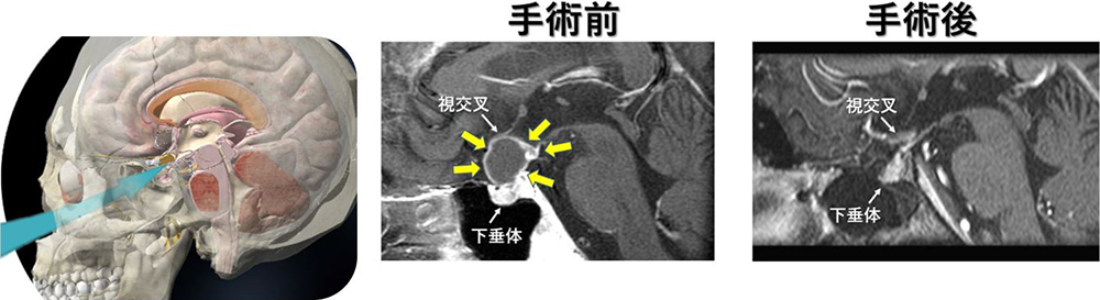 手術前と手術後の写真