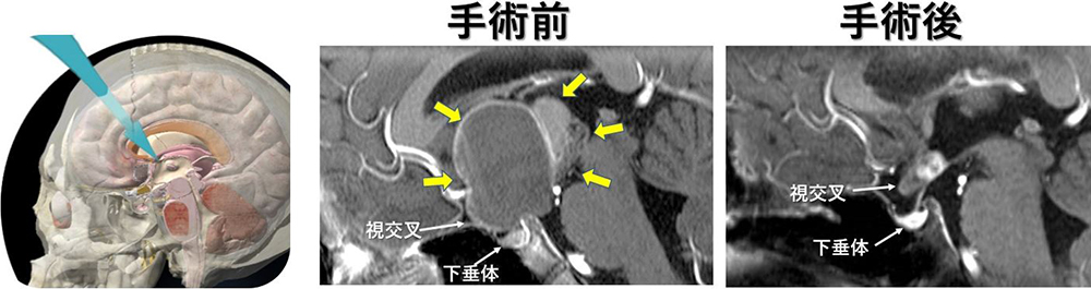 手術前と手術後の写真